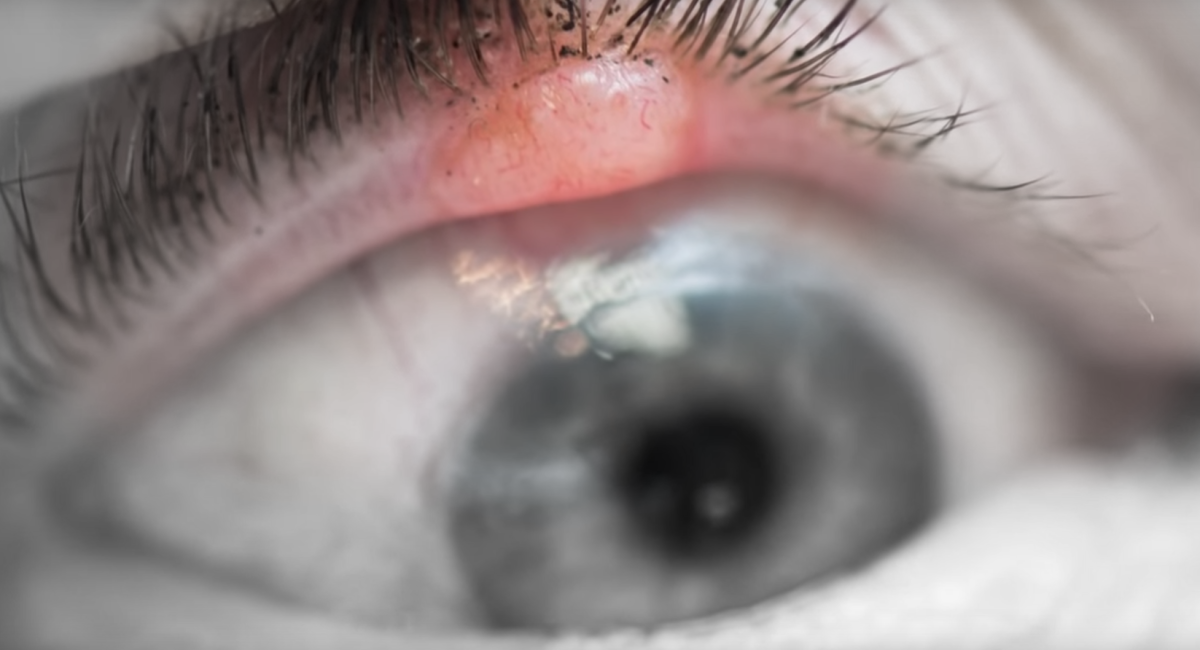 眼瞼腫瘤不能輕視，不但可以致盲還能夠致命