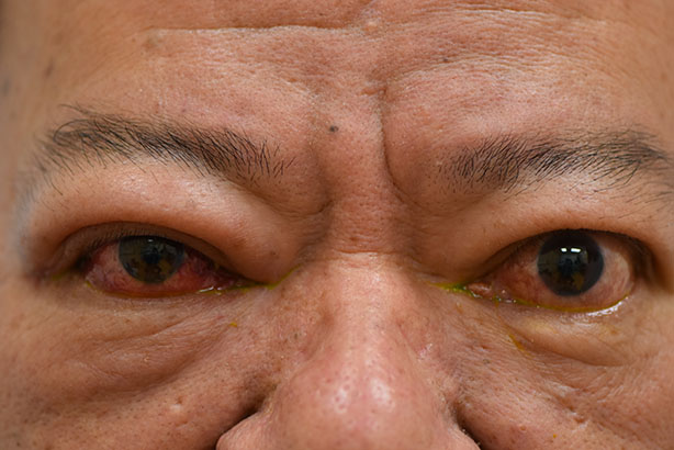 甲狀腺功能失調可影響眼睛（俗稱甲狀腺上眼）。患者可能出現眼皮紅腫上揚、眼凸、重影