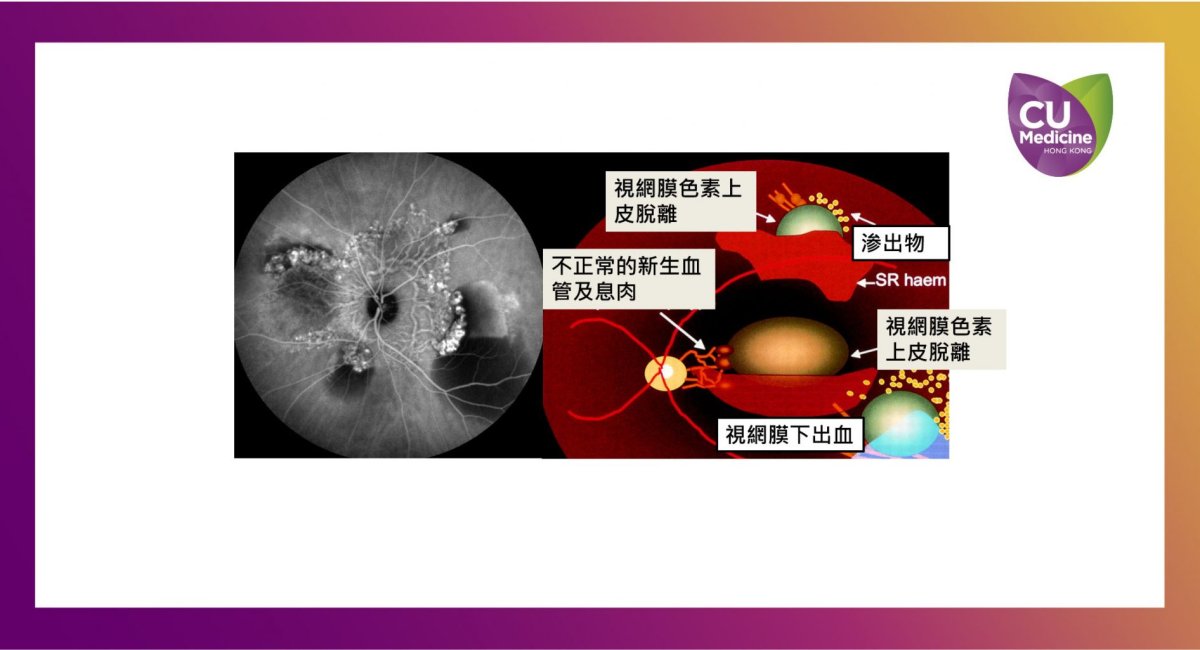 港約有50萬人患有黃斑病變，當中最棘手是「息肉狀脈絡膜血管病變」