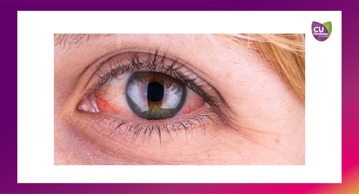 葡萄膜炎可致多種眼疾
