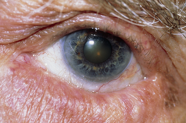 眼瞼內翻是指眼瞼邊緣向內翻捲，導致睫毛不停地與角膜和結膜產生磨擦