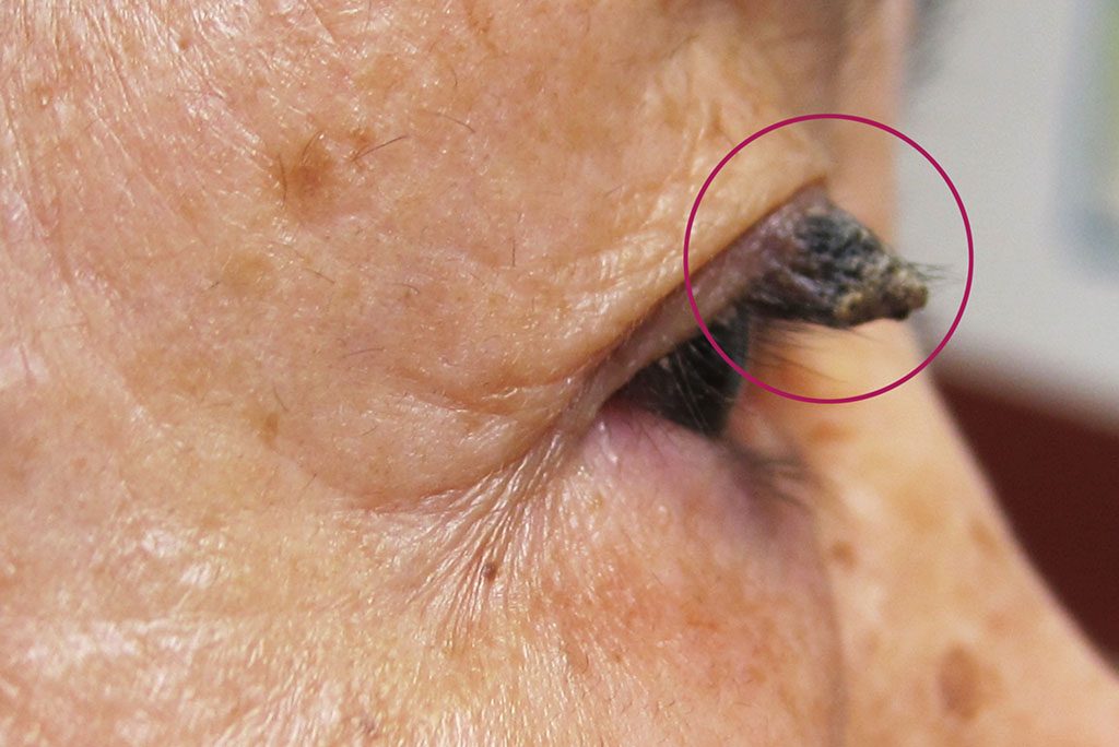 老人斑，學名為「脂漏性角化症」，是長者最常見的良性皮膚腫瘤